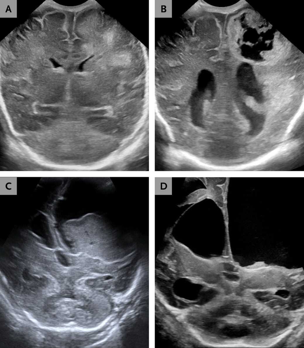 Смертельный менингит у младенцев вызван почвенным микроорганизмом Смертельный менингит у младенцев вызван почвенным микроорганизмом