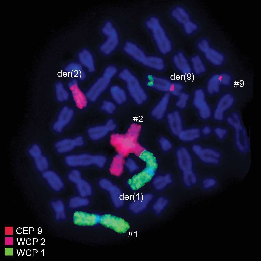 Хромосомные транслокации. Фотография, полученная методом FISH. «ДНК-паразиты» оказались ранними инициаторами хромосомного хаоса в раковых клетках