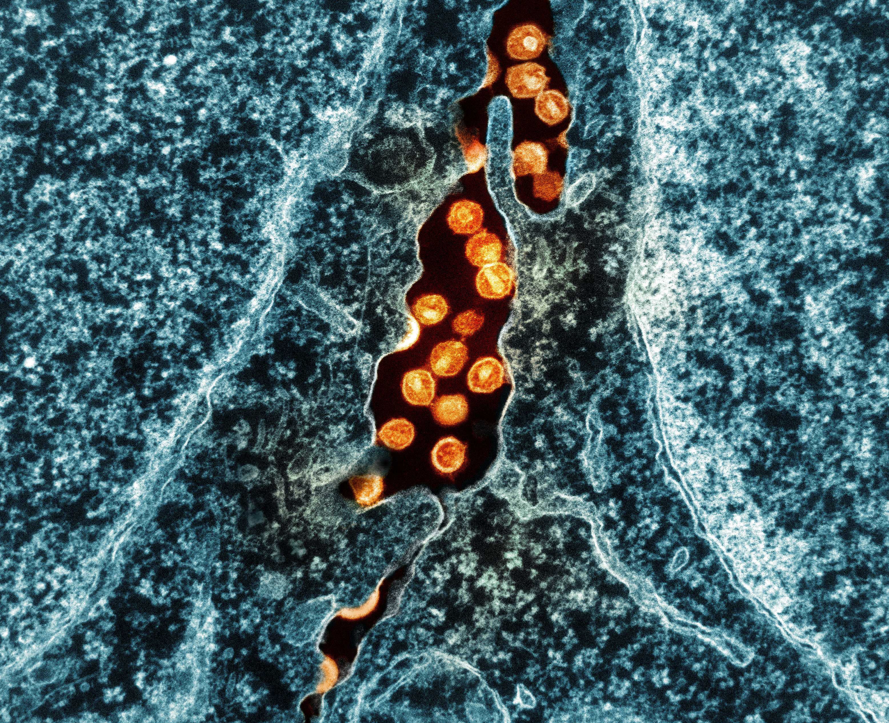 Норвежец избавился от ВИЧ после пересадки стволовых клеток брата Норвежец избавился от ВИЧ после пересадки стволовых клеток брата