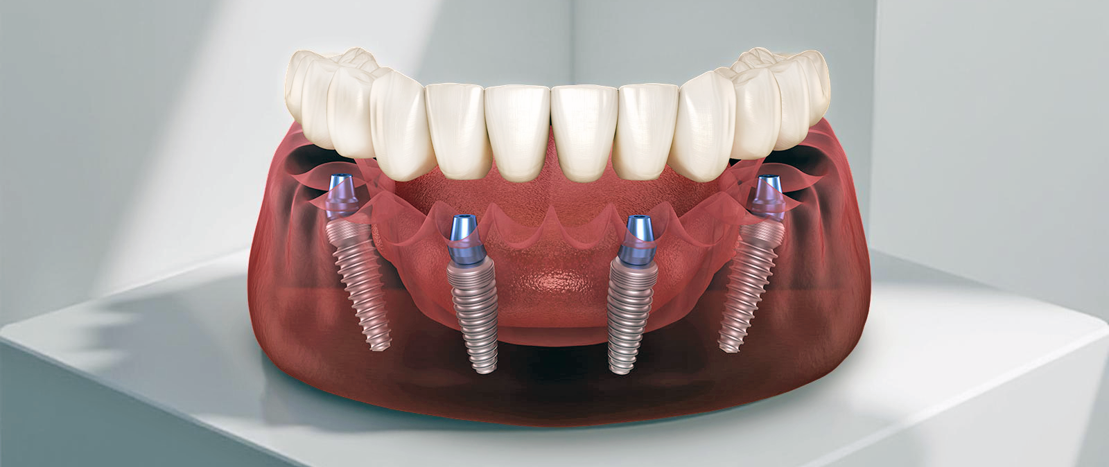 Имплантация All-on-4 в Балашихе: современное решение полной реставрации зубов Имплантация All-on-4 в Балашихе: современное решение полной реставрации зубов