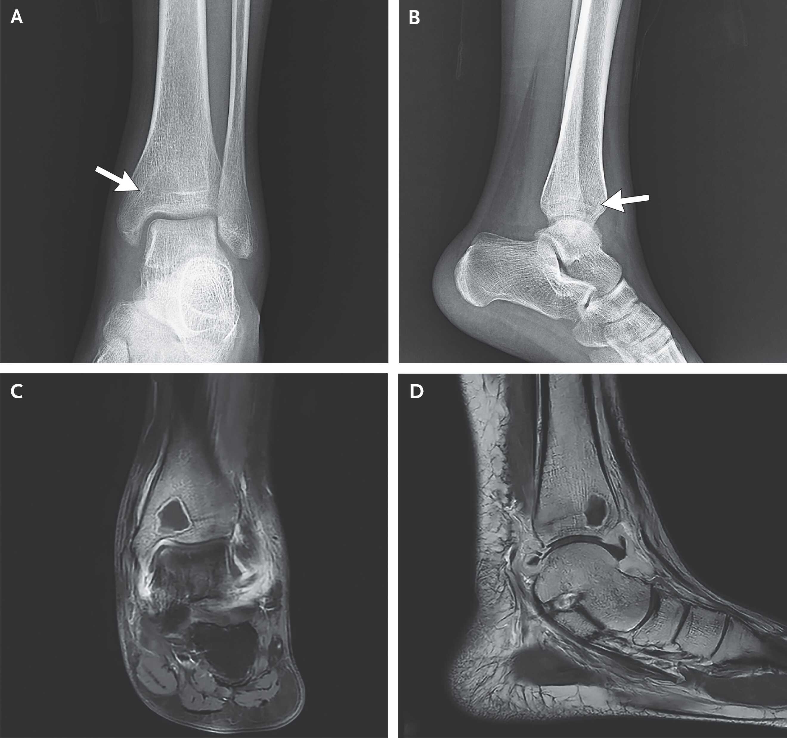 Сальмонелла вызвала у китаянки абсцесс кости Сальмонелла вызвала у китаянки абсцесс кости