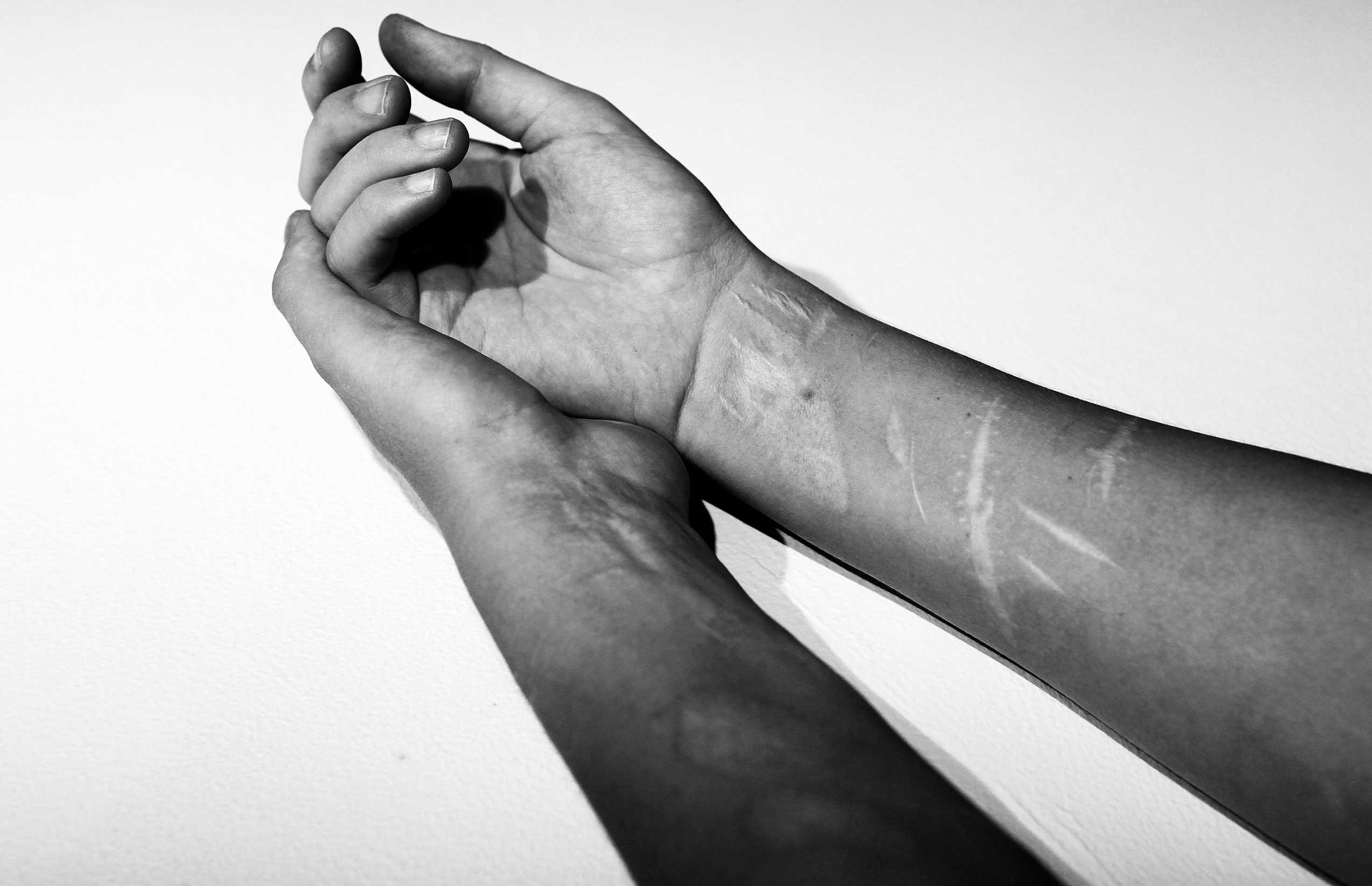 Терапия самоповреждений оказалась менее эффективной для мужчин Терапия самоповреждений оказалась менее эффективной для мужчин